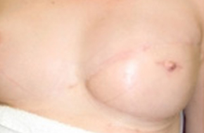Medische-tatoeage-images-9-voor